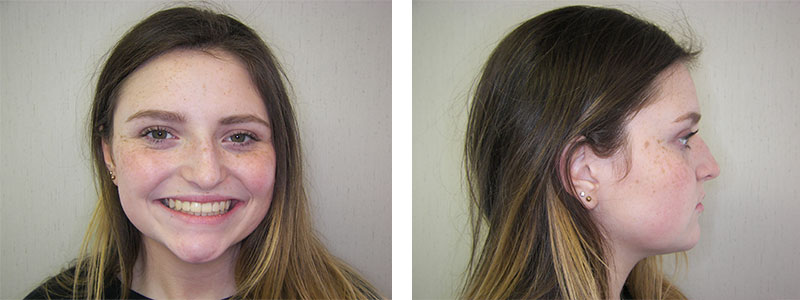 Before & Afters