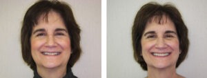 Before & Afters