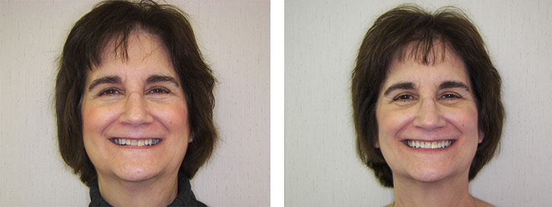 Before & Afters