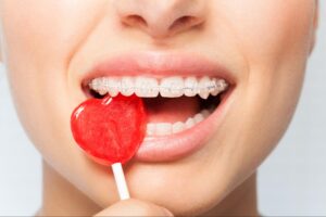 To Eat or Not To Eat: Braces Edition