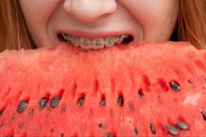To Eat or Not To Eat: Braces Edition