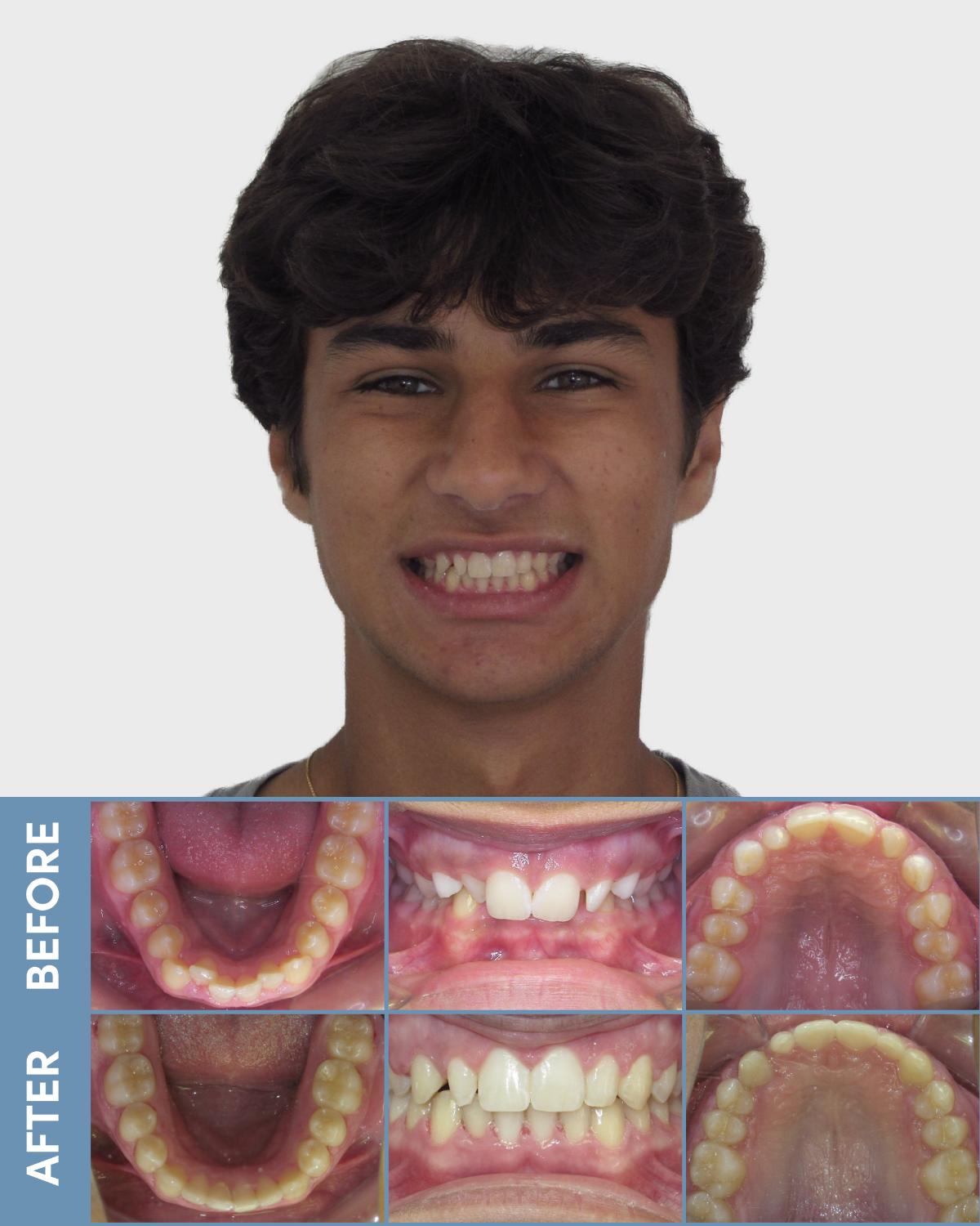 teen girl before and after