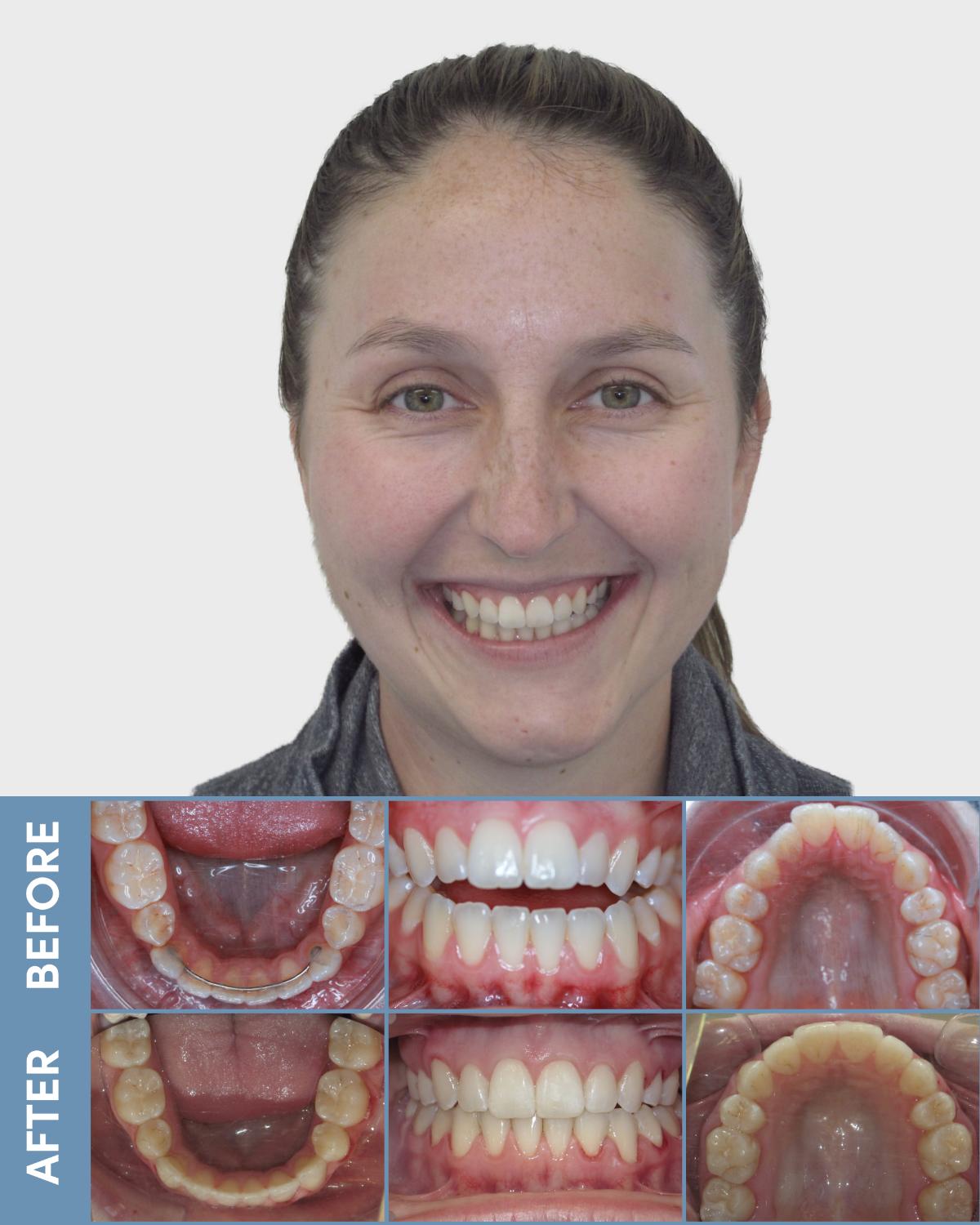 teen girl before and after